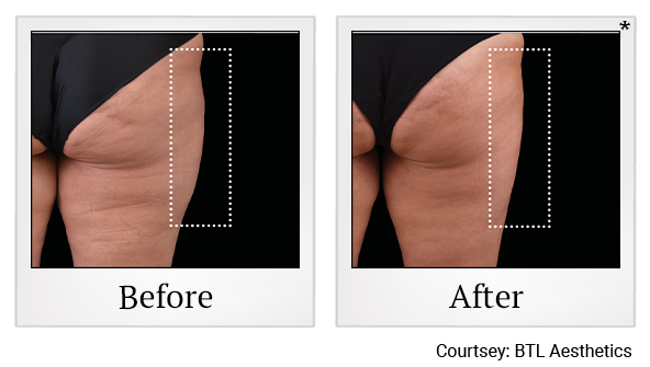 results for muscle toning in Wadsworth