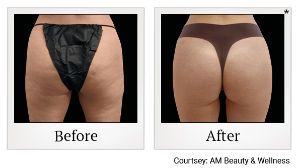 results for body contouring in Wadsworth