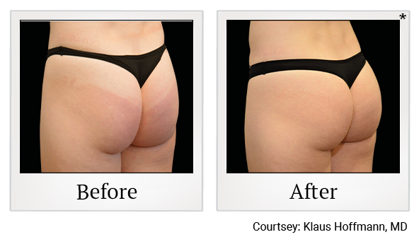 before ad after 8 of emsculpt neo treatment in Wadsworth