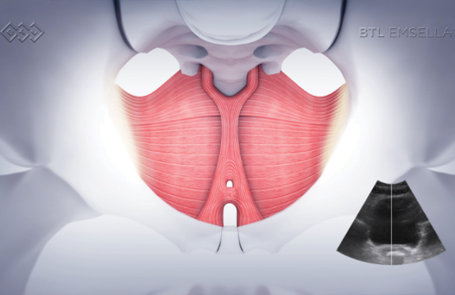 patient getting emsella in Wadsworth